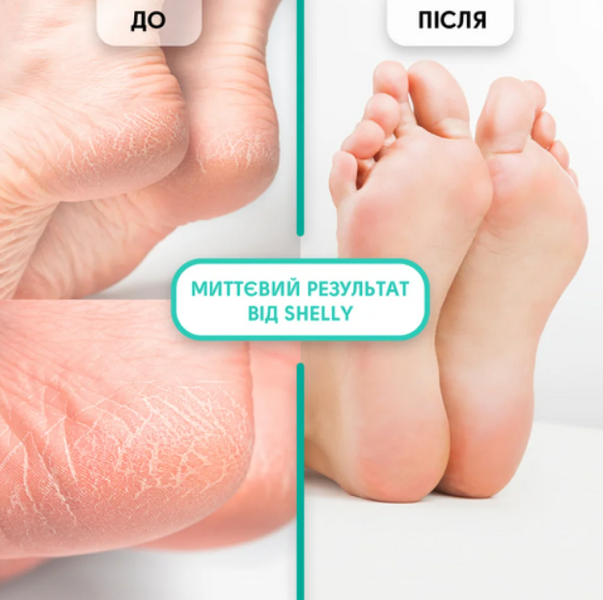 Гель-кератолитик для удаления мозолей и натоптышей Мягкое Лезвие Shelly, 200 мл 3604 фото